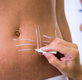 Абдомінопластика